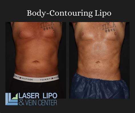 porno lipo|lipo videos